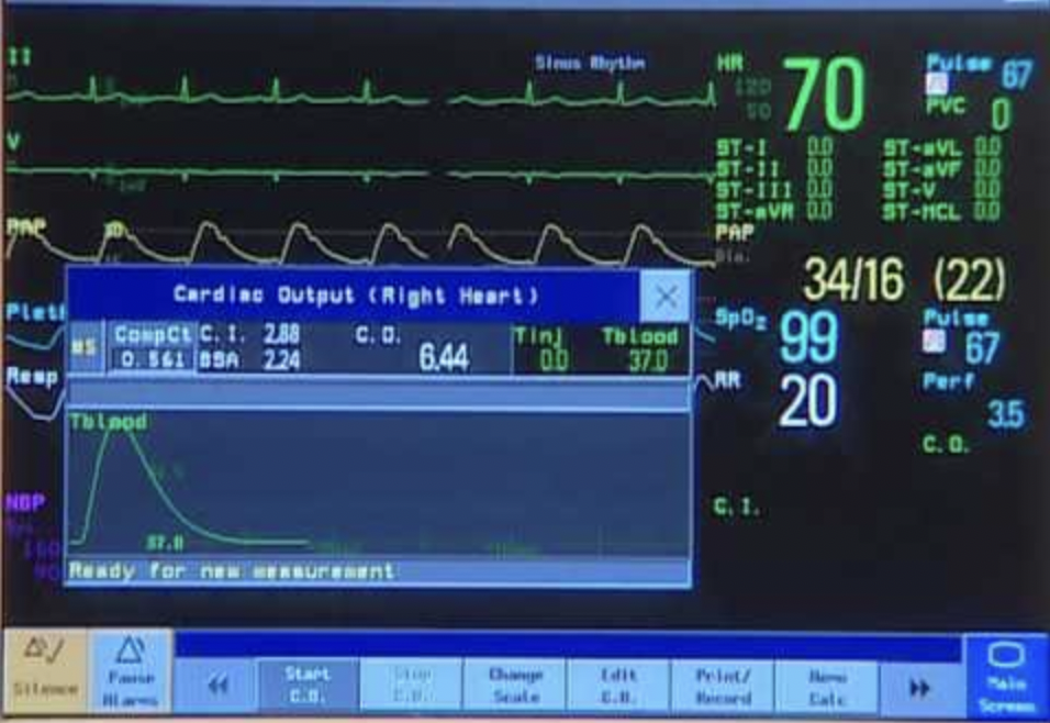 Patient Monitors – Cardiac Output